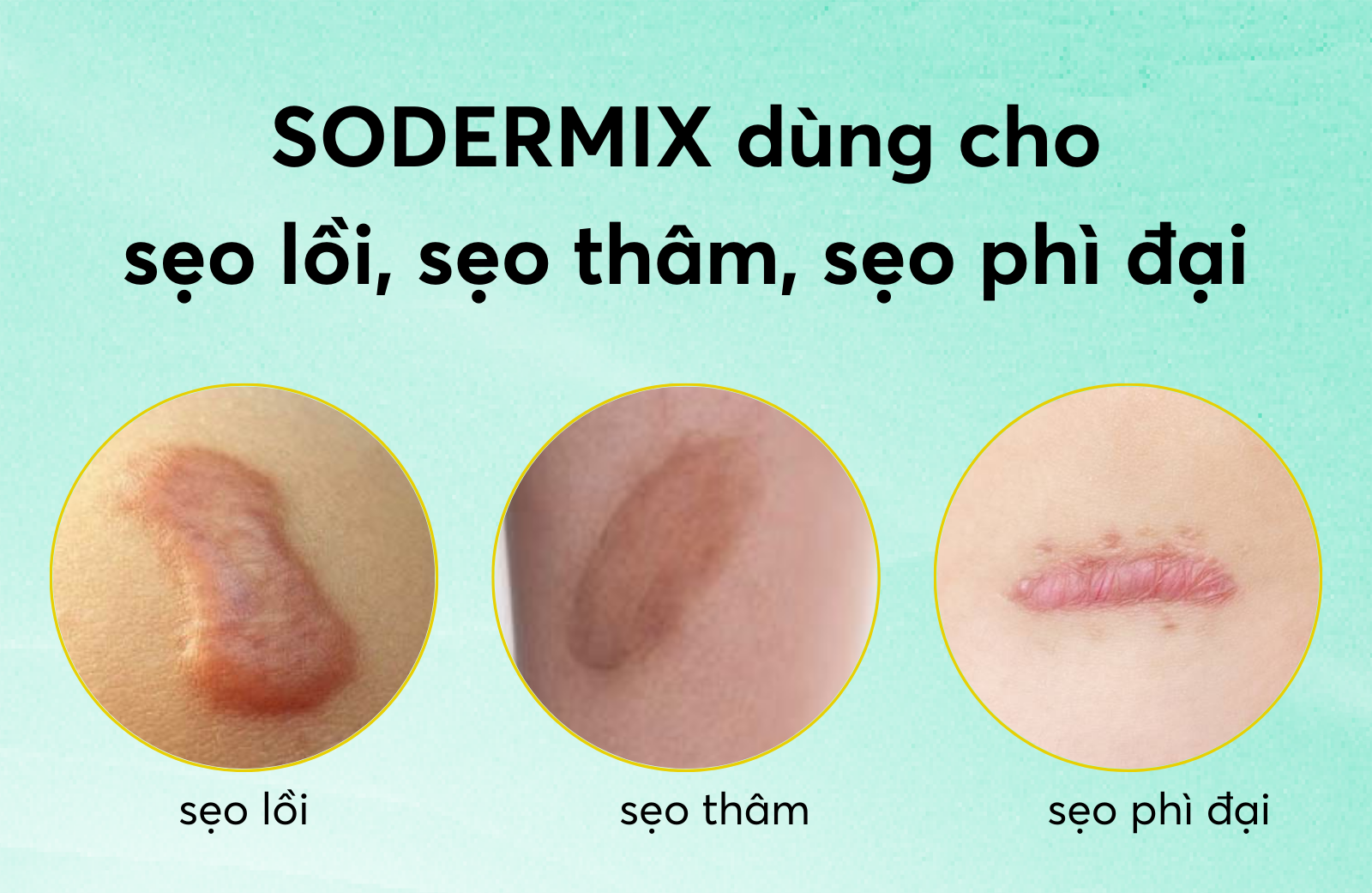 Mô tả Kem Bôi Sẹo Lồi, Sẹo Phì Đại - SODERMIX - Hỗ Trợ Làm Xẹp Sẹo Lồi, Sẹo Phì Đại, Mờ Sẹo Thâm - Nhập Từ Pháp - 1