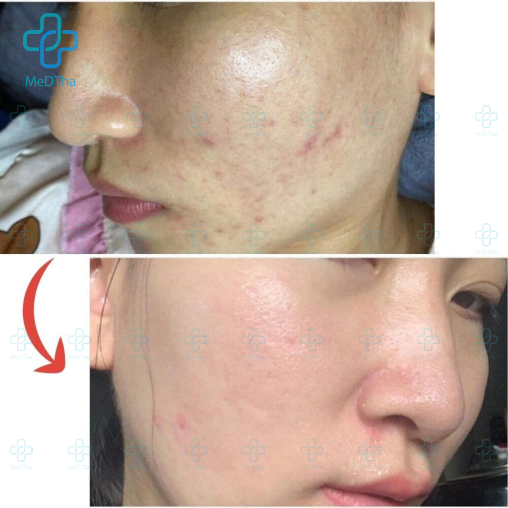 AzeMix Gel - Hỗ Trợ Mờ Thâm, Sáng Da, Ngừa Dầu, Phục Hồi Làn Da (Tuýp ...