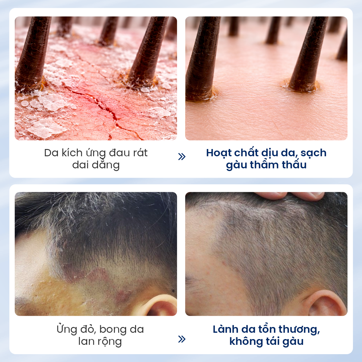 Combo kem và dầu gội hỗ trợ sạch gàu và bong tróc | Biocarepharma.