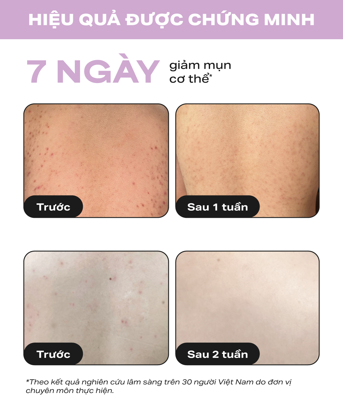 Kem dưỡng thể hỗ trợ giảm mụn và làm mịn da Paula's Choice 2% BHA Body Smoothing Spot Exfoliant - 5701