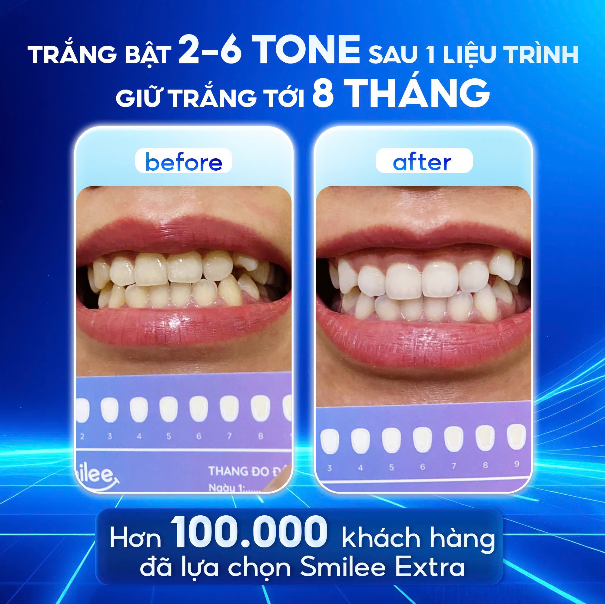 [GIÁ 657K TẠI LIVE SHOP] Trắng răng Smilee Extra, trắng răng từ 2-6 ...