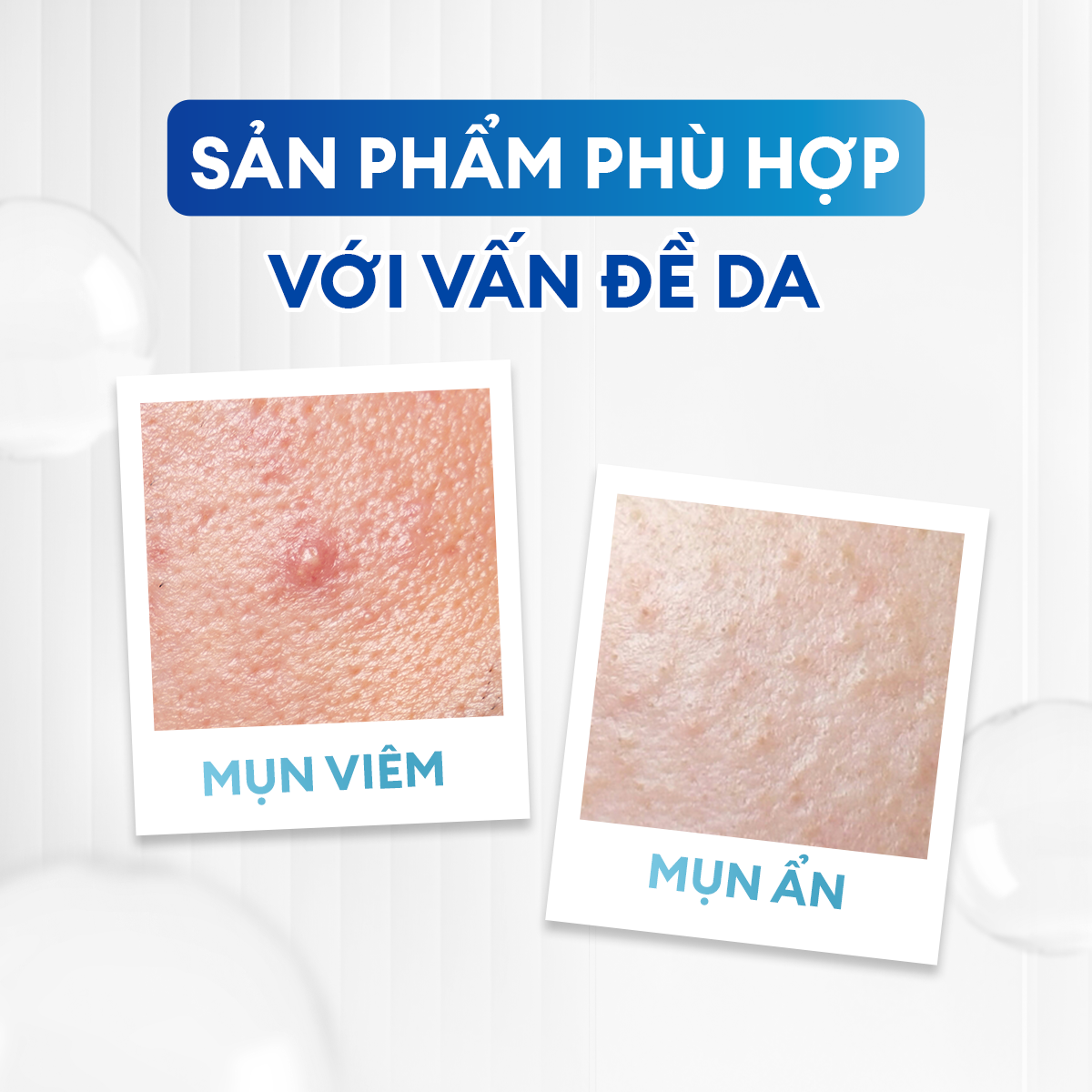 Combo Acne Duo giảm mụn sưng viêm cho nam Men Stay Simplicity: Sữa rửa mặt 100g và Serum Calm 30ml
