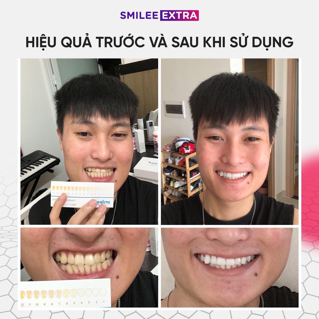 Trắng răng Smilee Extra, trắng răng từ 3-6 tone sau một liệu trình giúp hơi thở thơm mát tự tin. Hàng chính hãng