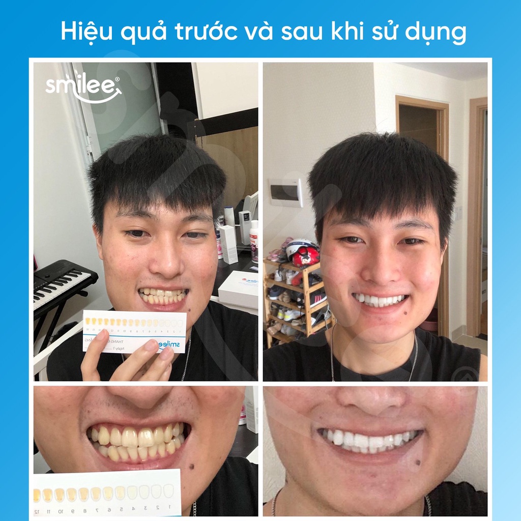 Trắng răng tại nhà Smilee Max, trắng từ 3 đến 6 tone sau 1 liệu trình, ngăn ngừa sâu răng, viêm nướu. Hàng chính hãng