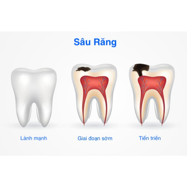 Răng sâu Patar 75 M16 giảm nhức răng hết sâu răng giảm ê buốt răng hiệu quả tức thì cam kết an toàn;.